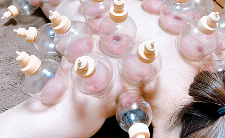 写真：カッピングの施術